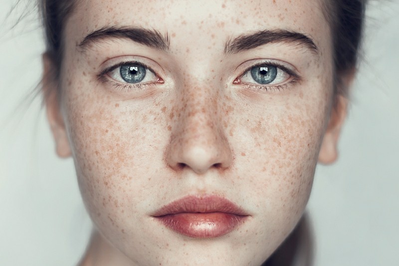 ฝ้า สาเหตุ ป้องกัน รักษา Face Freckles